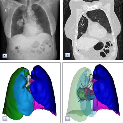 Lung adenocarcinoma concurrent with congenital pulmonary aplasia of the right upper lobe: A case report